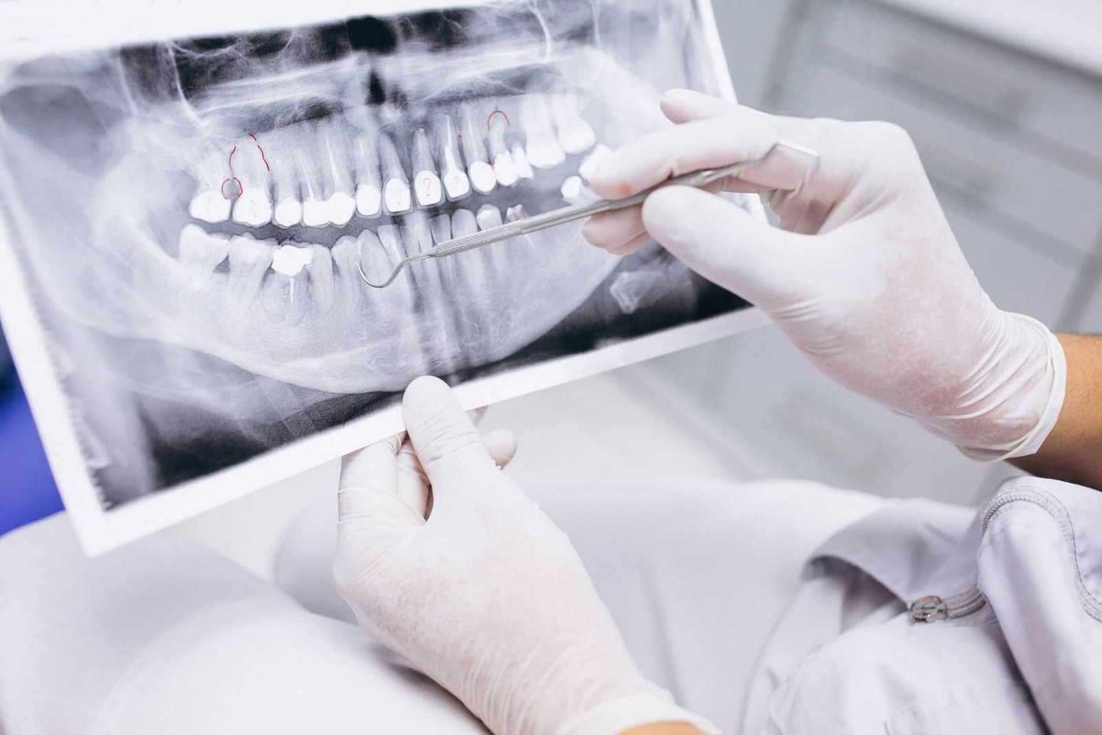 implantes cortos clinica dental doctor charani