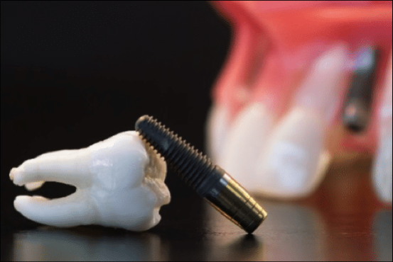 implantes post extraccion