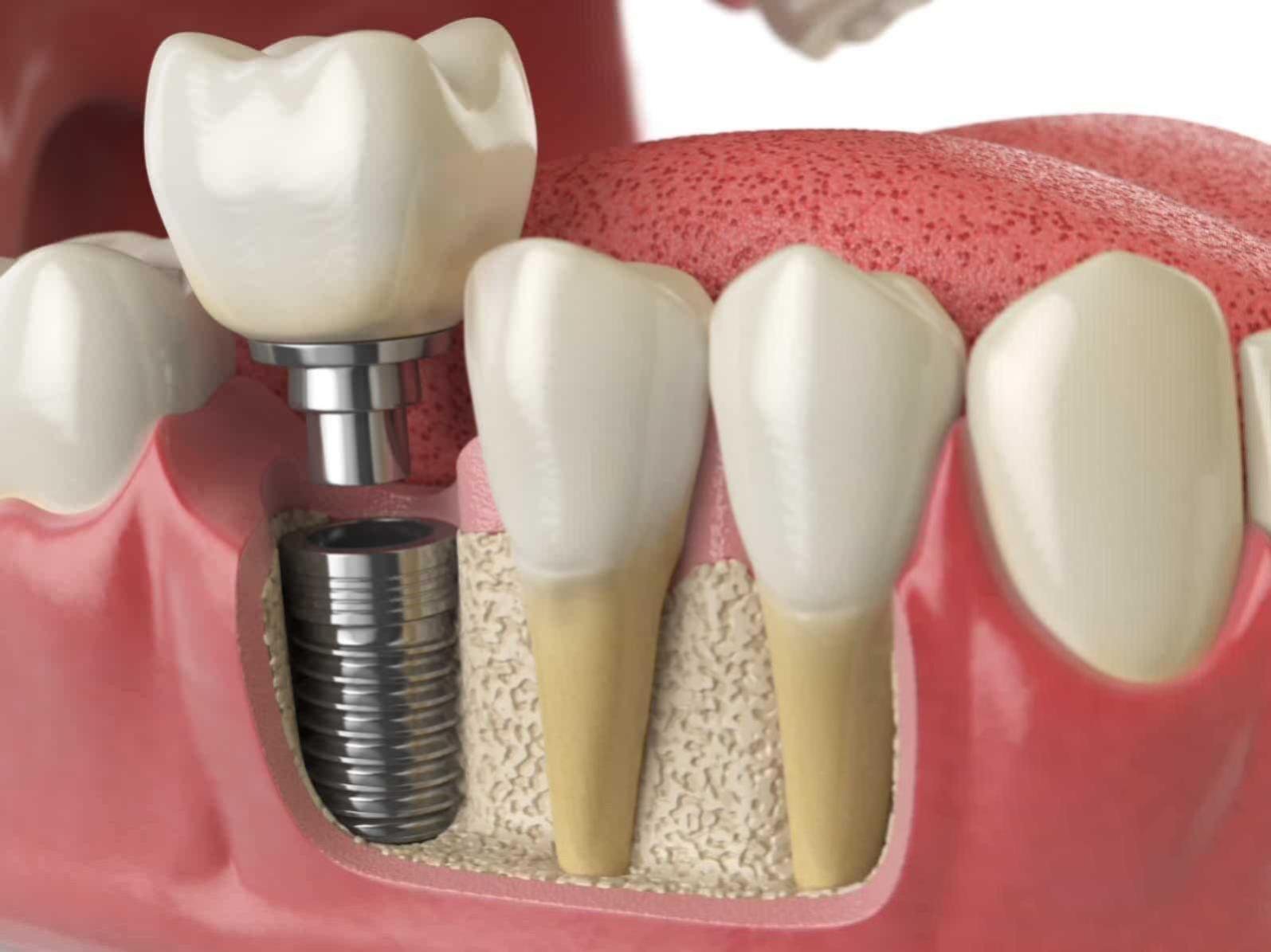 render de una implantología dental