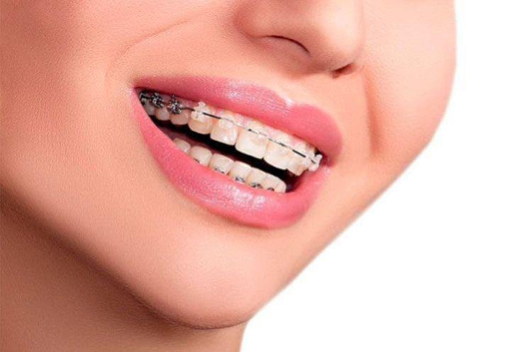 Aparatos dentales blancos sobre sonrisa bonita