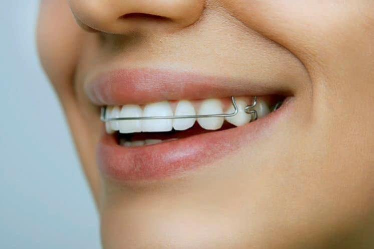 mujer con aparatos dentales de barra metálica