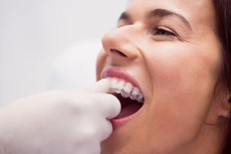 dentista que ayuda a paciente a colocarse ortodoncia invisible